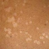 Хроническое заболевание кожи питириаз