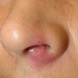 Опасность фурункула в области носа