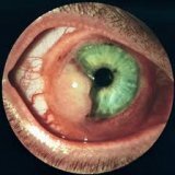 Злокачественные опухоли глазного яблока