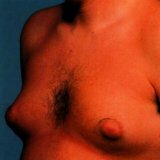 Причина увеличения груди у мужчин