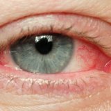 Острая и хроническая вирусная инфекция глаз