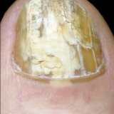Грибок стопы и ногтей народное лечение