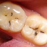Проблемы с зубами или заболевание кариес
