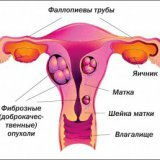 Причины и лечение обильных менструаций