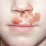 Заболевание кожи носа у человека