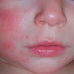 Атопический дерматит у детей признаки проявления