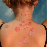 Гомеопатия лечение кожных заболеваний