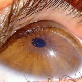Заболевания наружной сетчатки глаза
