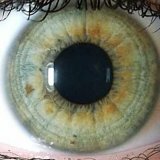 Диагностика болезней по радужке глаза