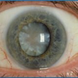 Причины заболевания катаракты у человека