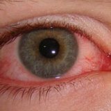 Глазная болезнь вирус герпеса