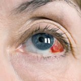 Основные причины кровоизлияний в глаза
