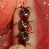 Имплантация зубов наркоз возможные осложнения