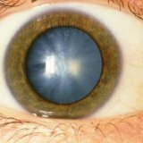Лечение катаракты в пожилом возрасте