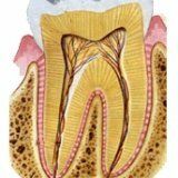 Удаление нерва в зубе с помощью мышьяка