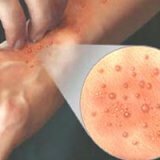Заболевание кожи контактный дерматит