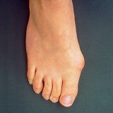 Вальгусная деформация пальцев стопы