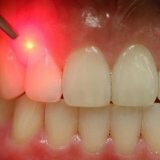 Лечение кариеса без сверления зубов