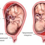 Как влияет положение плаценты на беременность и роды