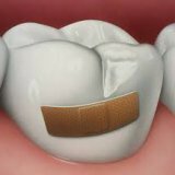 Причины развития кариеса зубов и профилактика