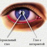 Разновидности заболевания катаракта у человека