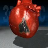 Сердечно-сосудистое заболевание инфаркт миокарда