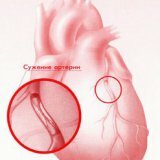 Ишемическая болезнь сердца человека