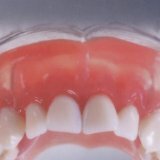 Как меняется жизнь с зубными протезами