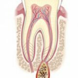 Причины возникновения и лечение кисты зуба
