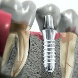 Одномоментная имплантация в стоматологической практике