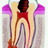 Апикальный периодонтит временных зубов