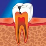 Кариес зубов причины и профилактика