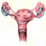 Патогенная пролиферация эндометрия у женщин