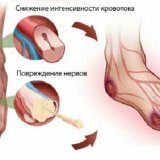 Патология стопы при сахарном диабете