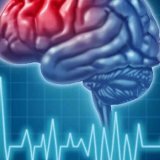 Лечение и профилактика инсульта головного мозга
