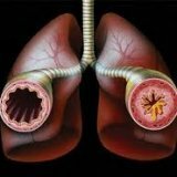 Лечение бронхиальной астмы натуральными средствами