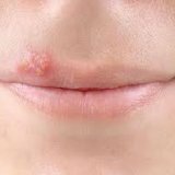 Основные причины возникновения герпеса на губах
