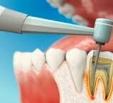 Что нужно знать о чистке зубных каналов